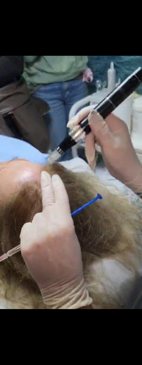 סידרת 10 טיפולי מזותרפיה לעידוד צמיחת השיער, מתאים לנשים וגברים