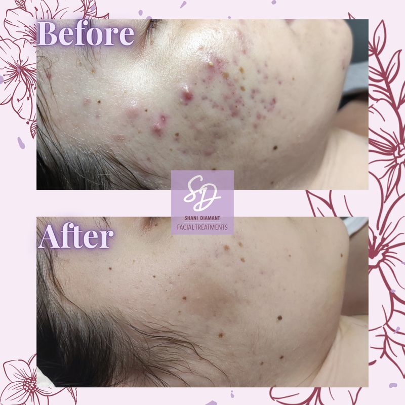 SD Facial Treatments - תמונה 2