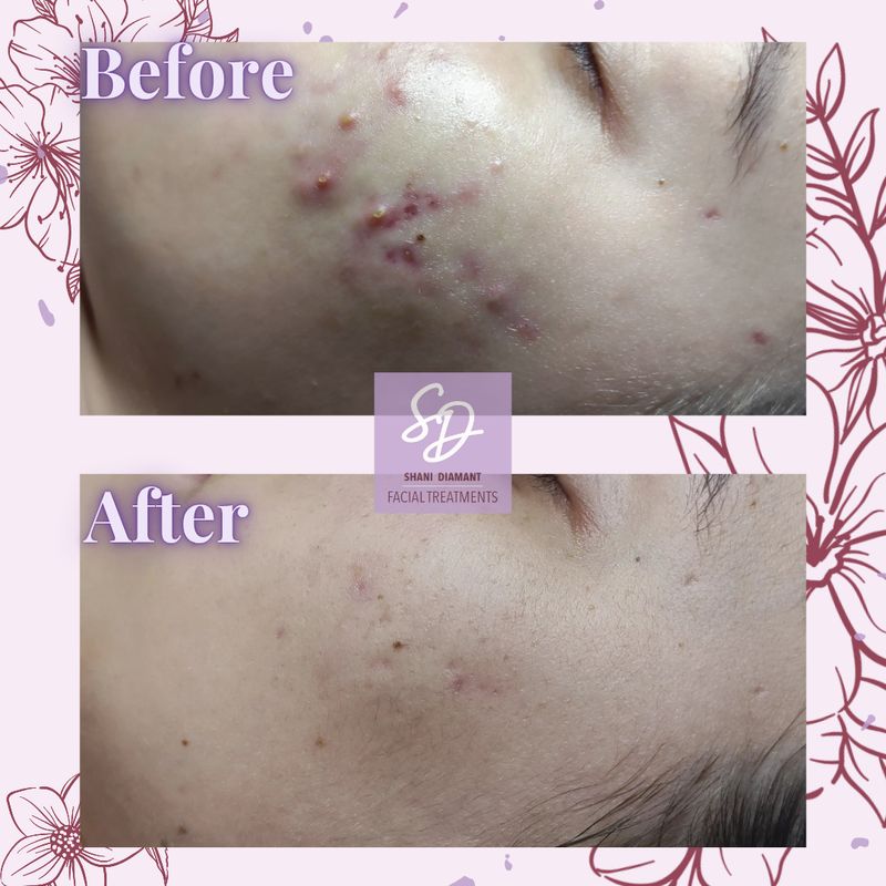 SD Facial Treatments - תמונה 3