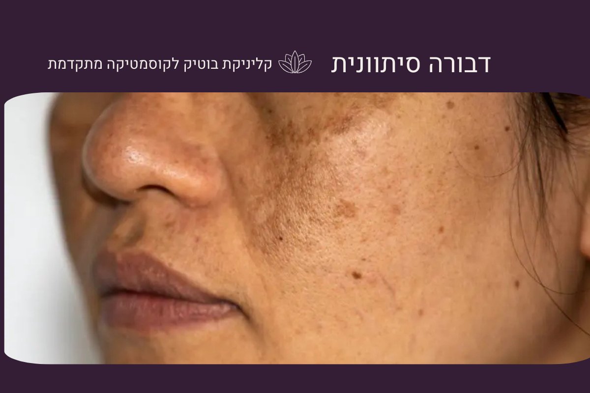 טיפול בפיגמנטציה וכתמי עור