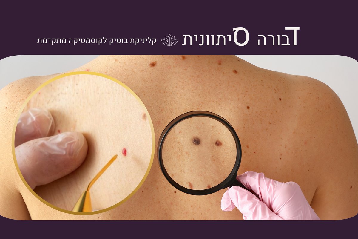 הסרת נגעי עור